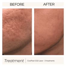 Load image into Gallery viewer, CoolPeel CO2 Laser Skin Resurfacing