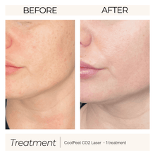 Load image into Gallery viewer, CoolPeel CO2 Laser Skin Resurfacing