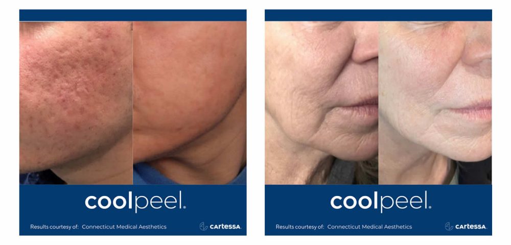 CoolPeel CO2 Laser Skin Resurfacing